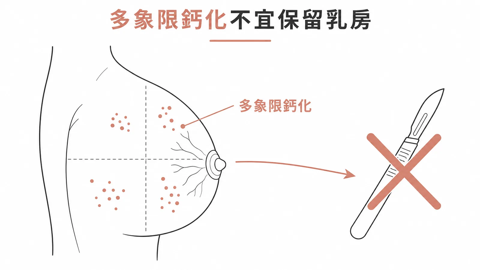 多象限鈣化散佈不宜行乳房保留手術