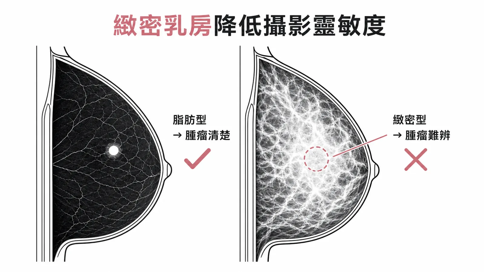 緻密乳房降低乳房攝影靈敏度——脂肪型腫瘤清楚vs緻密型腫瘤難辨