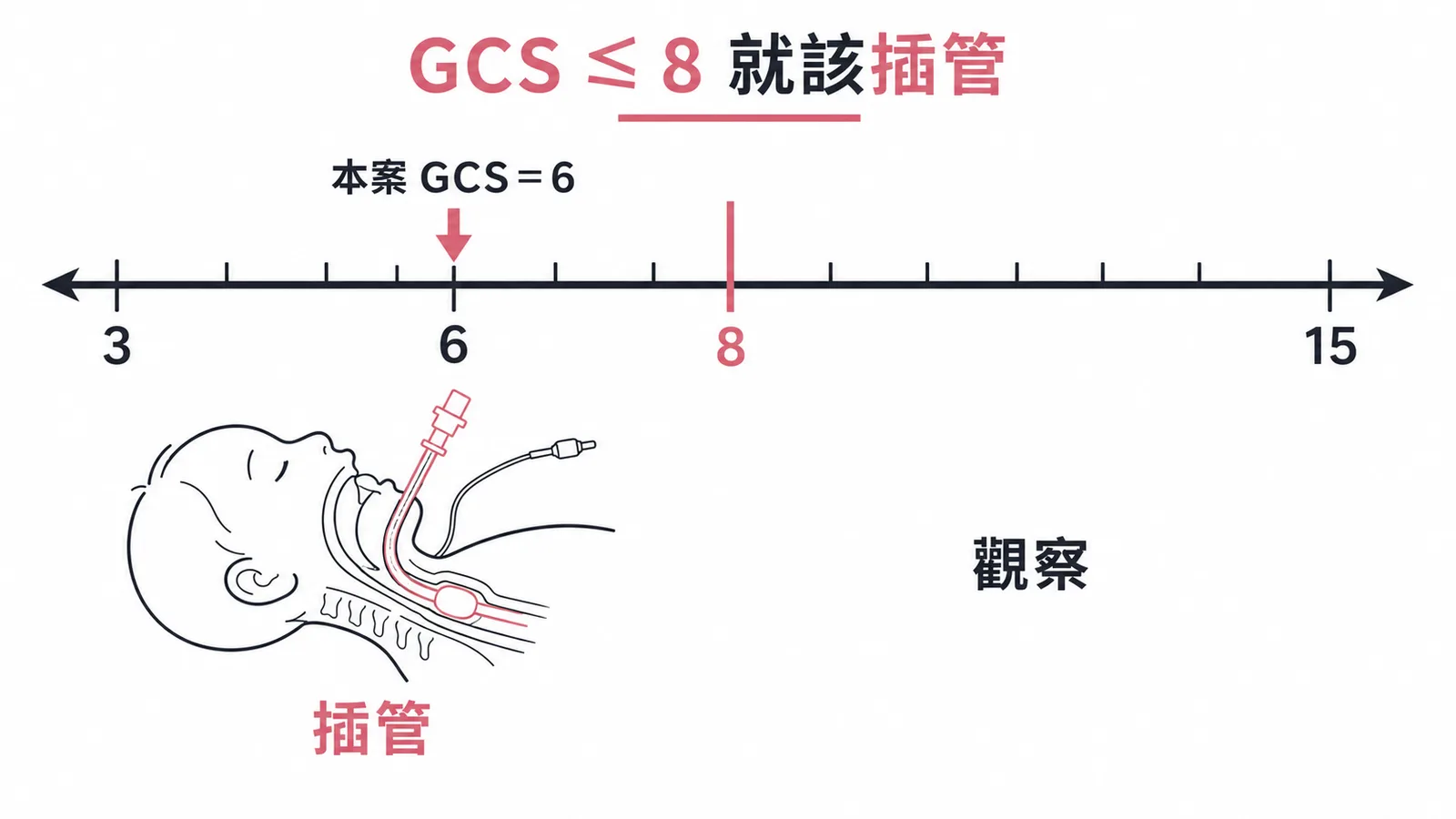 GCS ≤ 8 即應插管保護呼吸道，本案 GCS = 6
