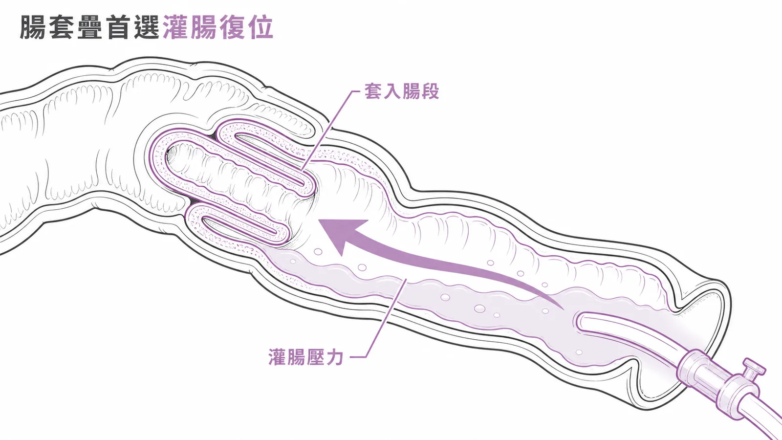 腸套疊首選灌腸復位：液壓或氣壓將套入腸段推回