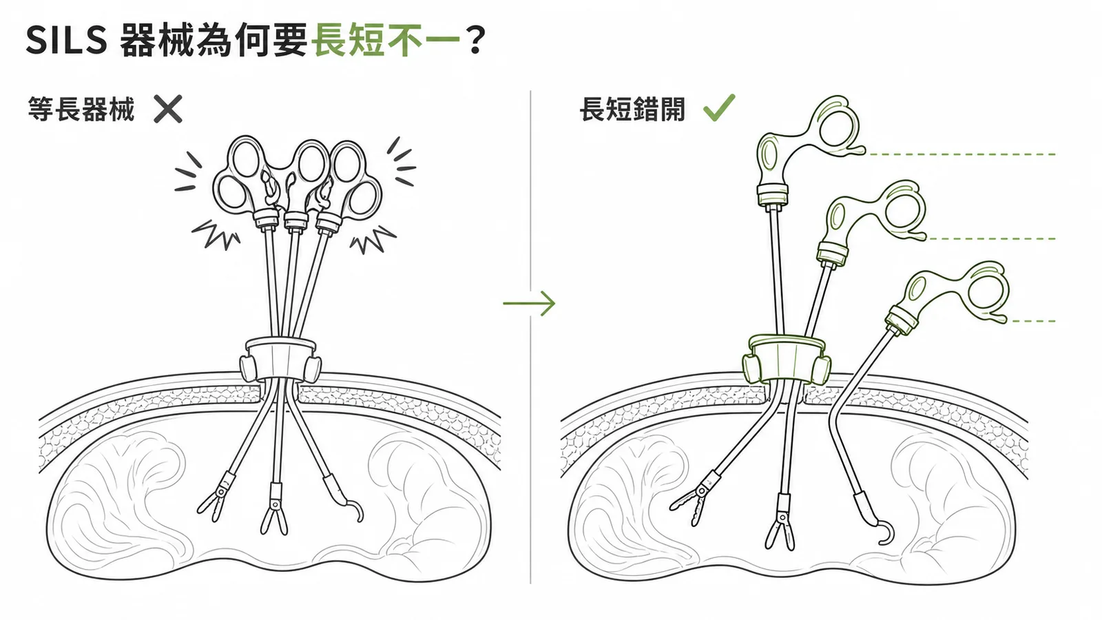 SILS手術使用長短不一器械減少碰撞