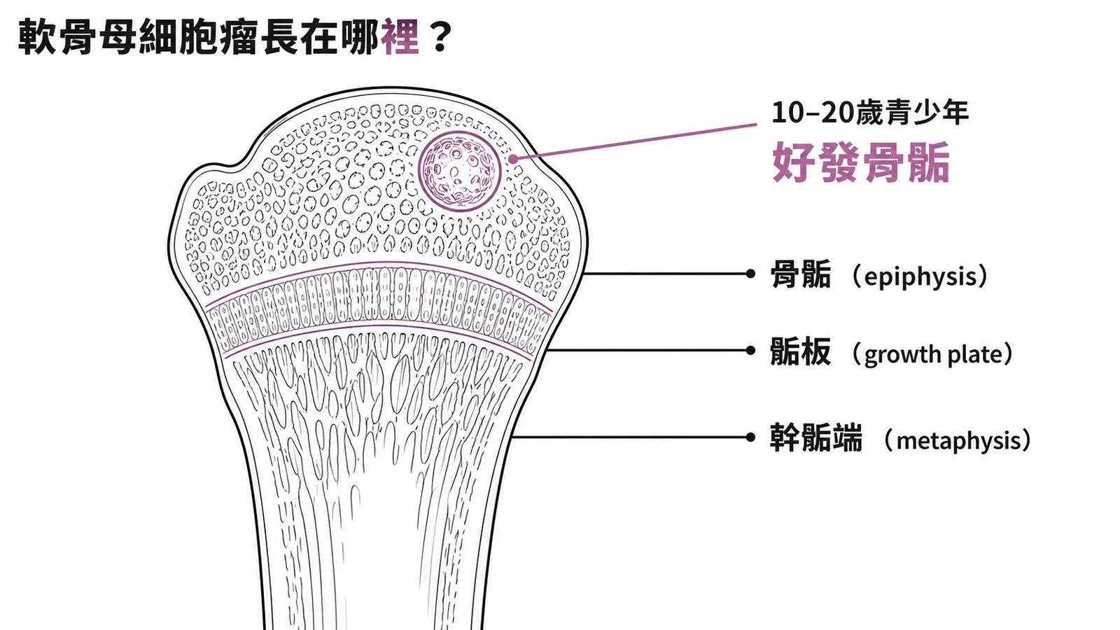 軟骨母細胞瘤好發於青少年長骨骨骺