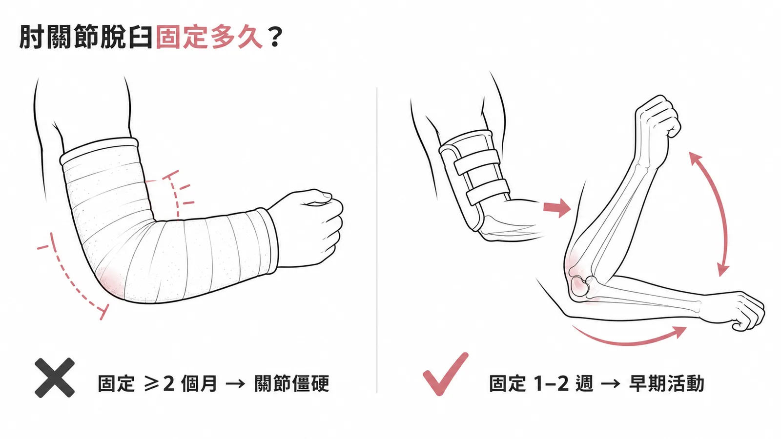 肘關節脫臼復位後應短期固定1-2週再早期活動
