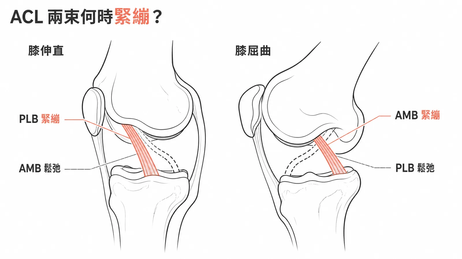 ACL前內側束屈曲時緊繃、後外側束伸直時緊繃