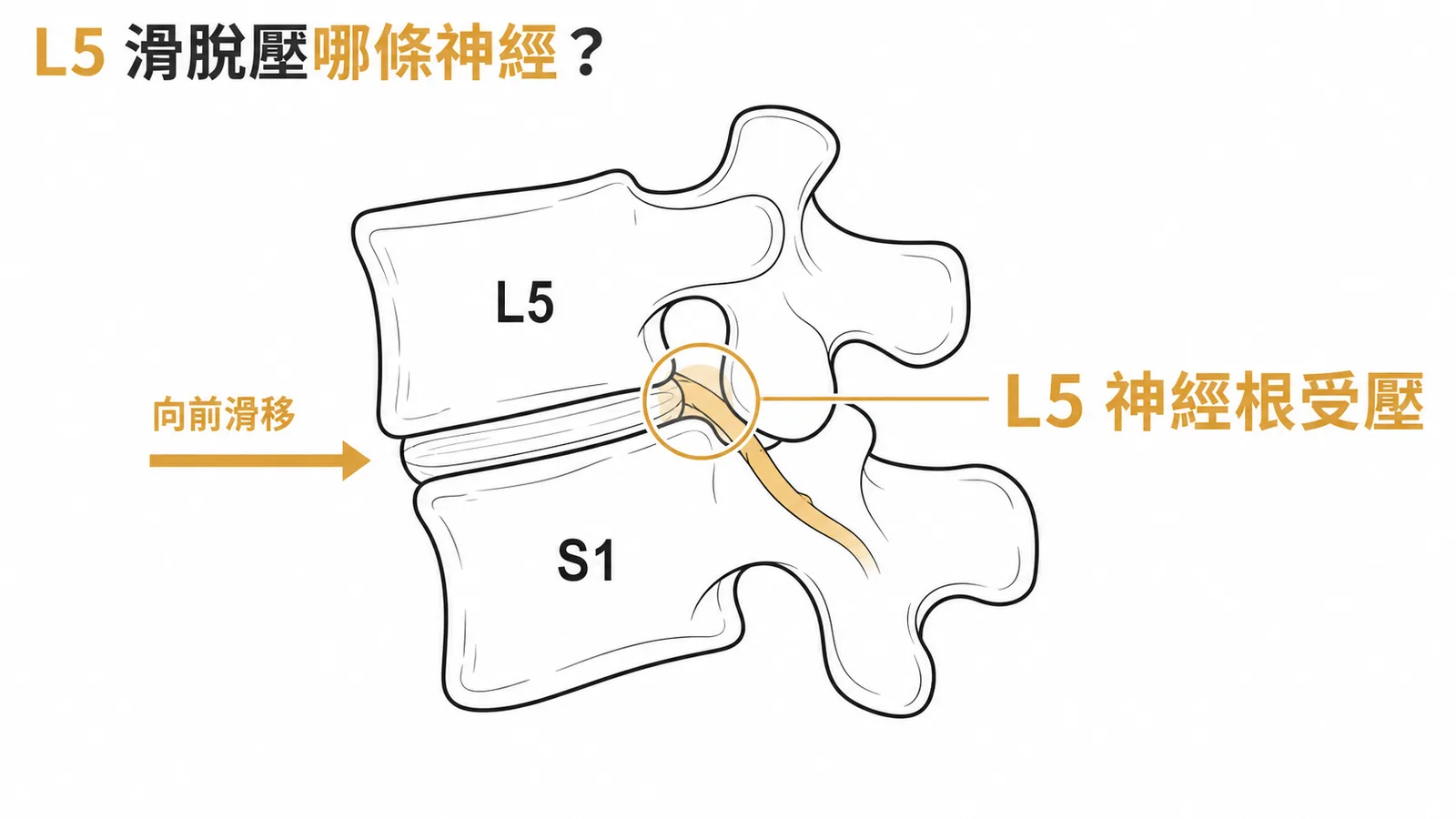 L5椎體前移壓迫L5神經根