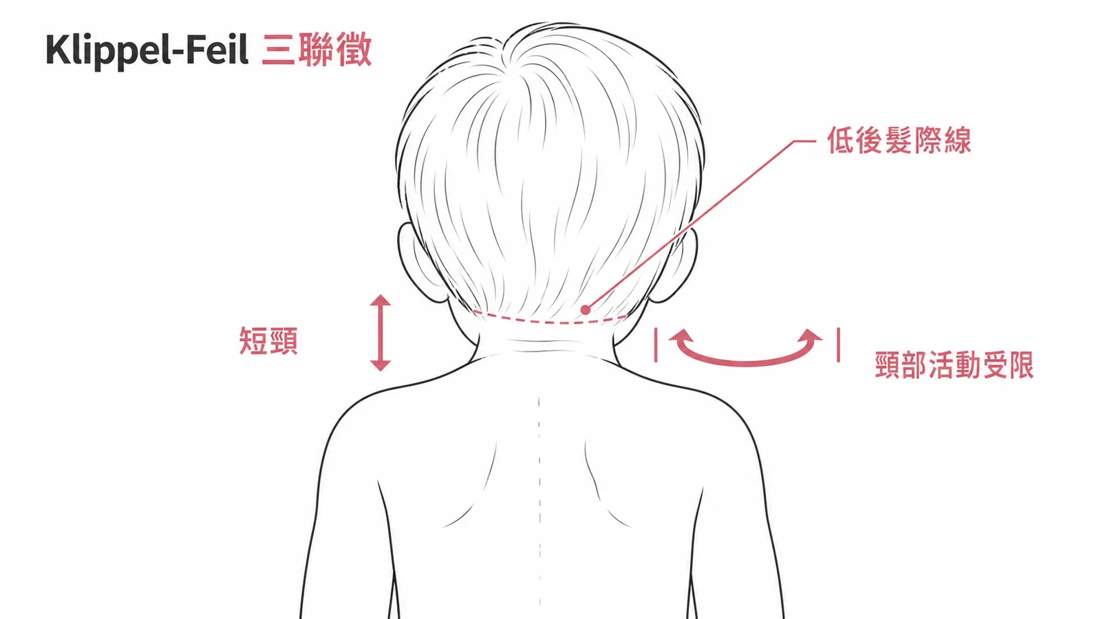 Klippel-Feil三聯徵：短頸、低後髮際線、頸部活動受限