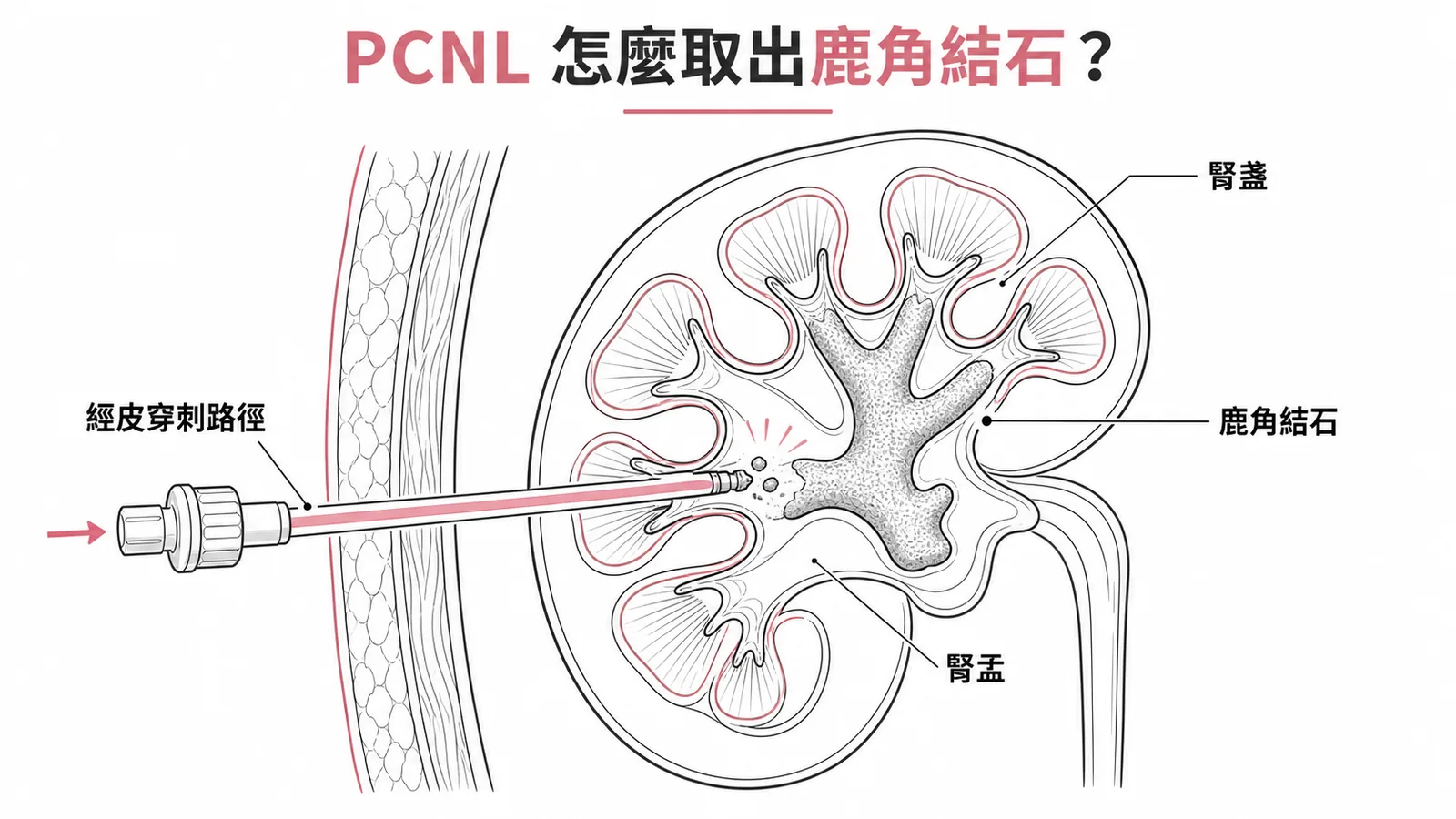 PCNL 經皮穿刺取出腎臟鹿角結石示意圖