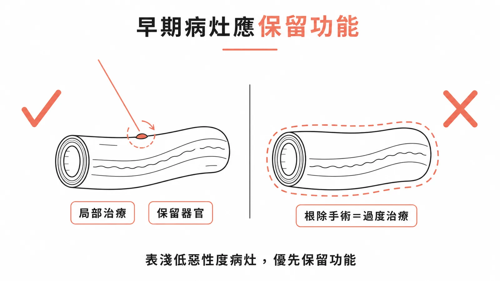 早期低惡性度陰莖癌應保留器官功能而非根除手術