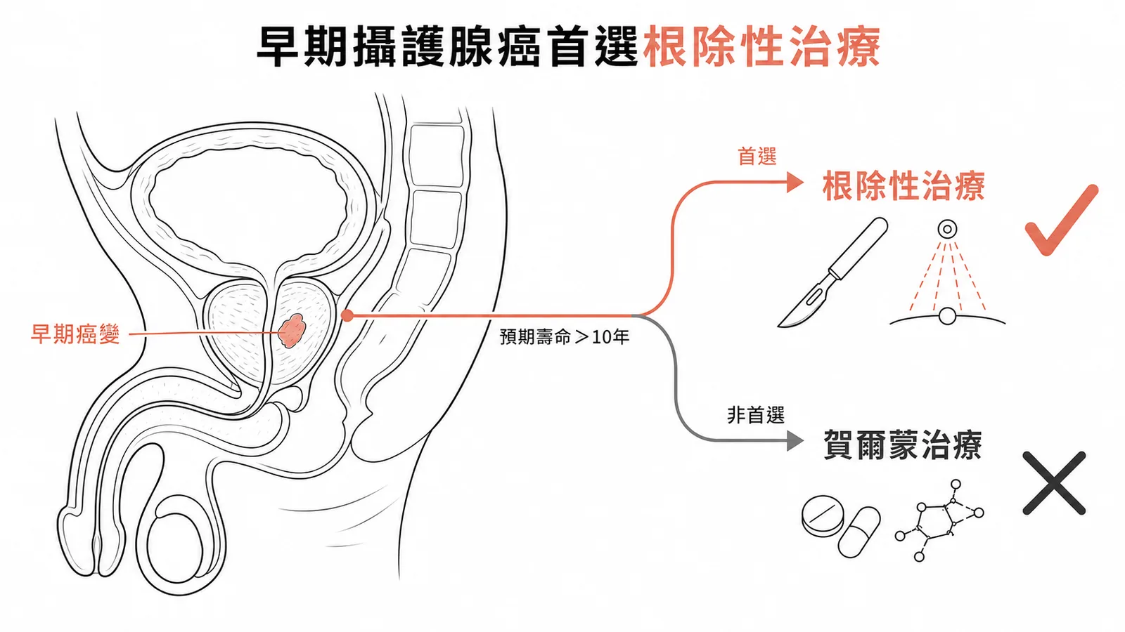 早期攝護腺癌首選根除性治療而非賀爾蒙治療