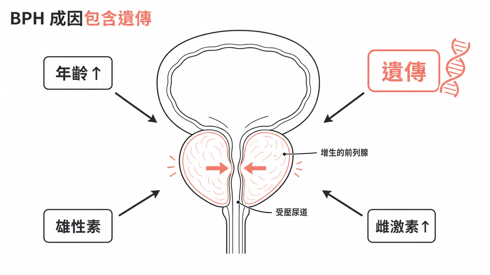 BPH 成因包含遺傳等多種因素