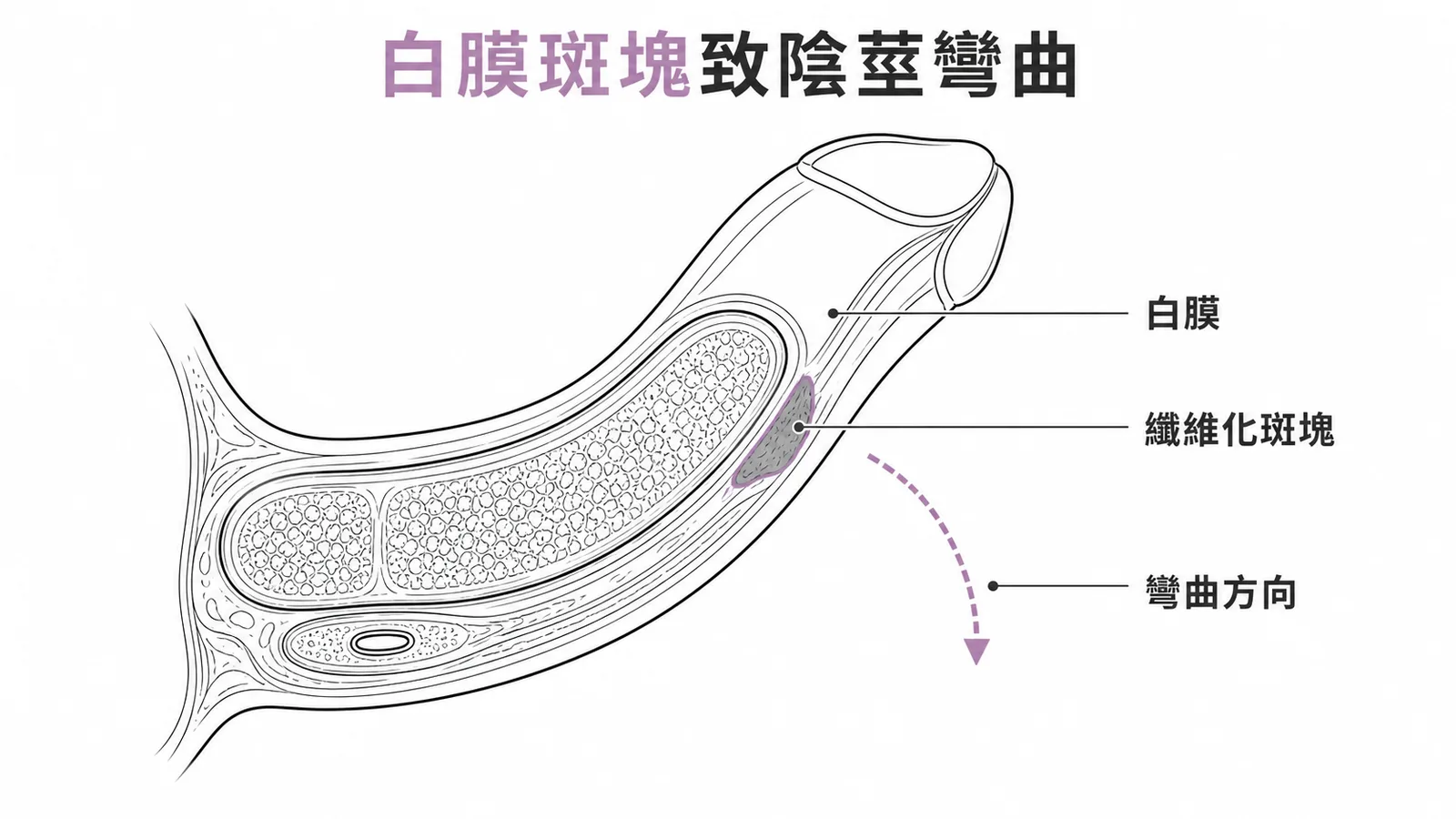 Peyronie 病白膜纖維化斑塊致陰莖彎曲示意圖