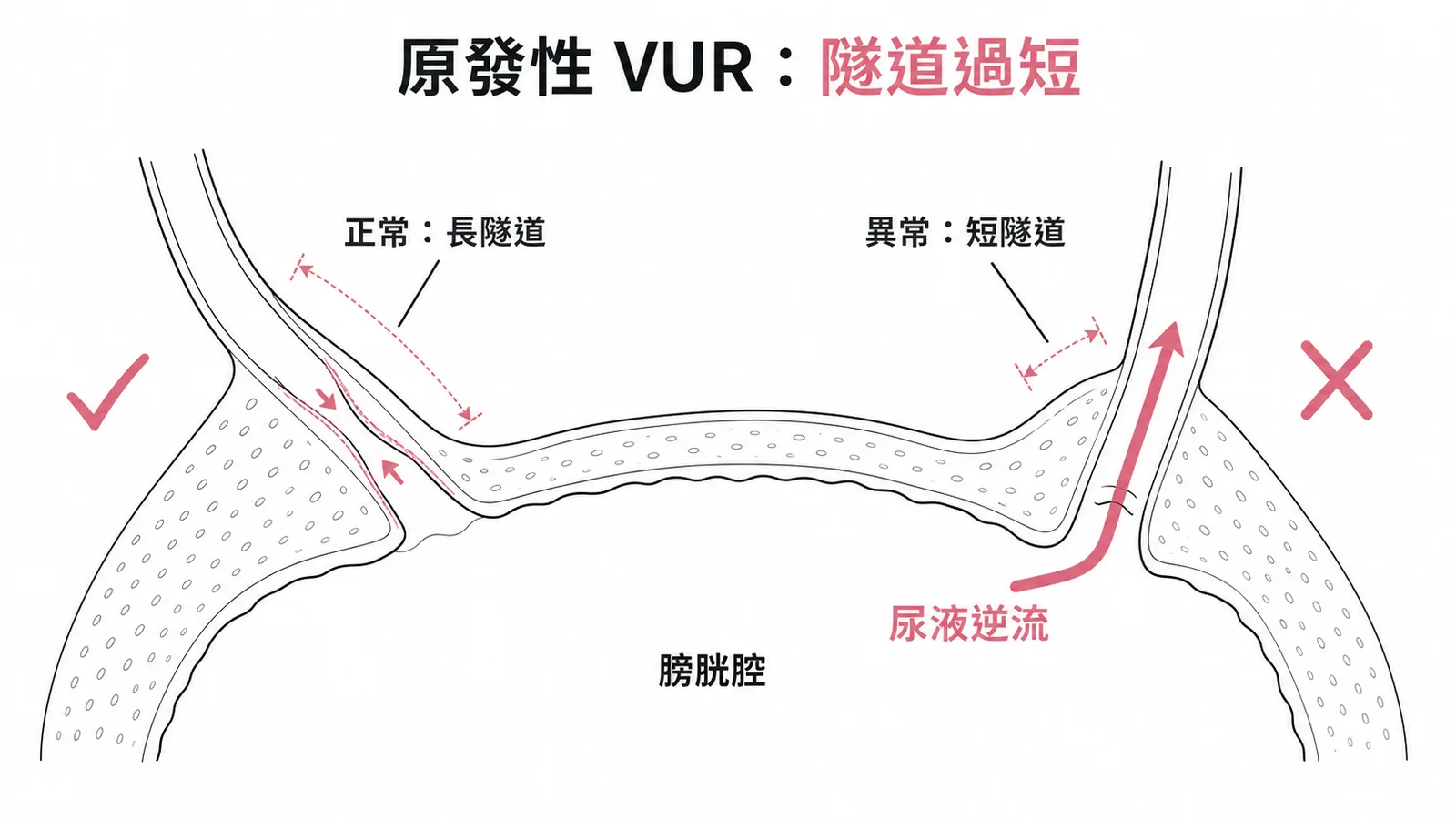 原發性 VUR 膀胱輸尿管接合處隧道過短導致逆流