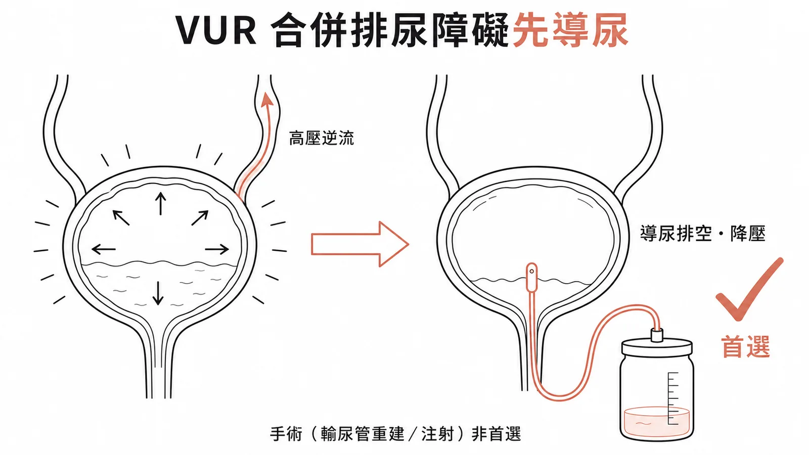 VUR 合併排尿障礙首先以導尿排空膀胱降壓