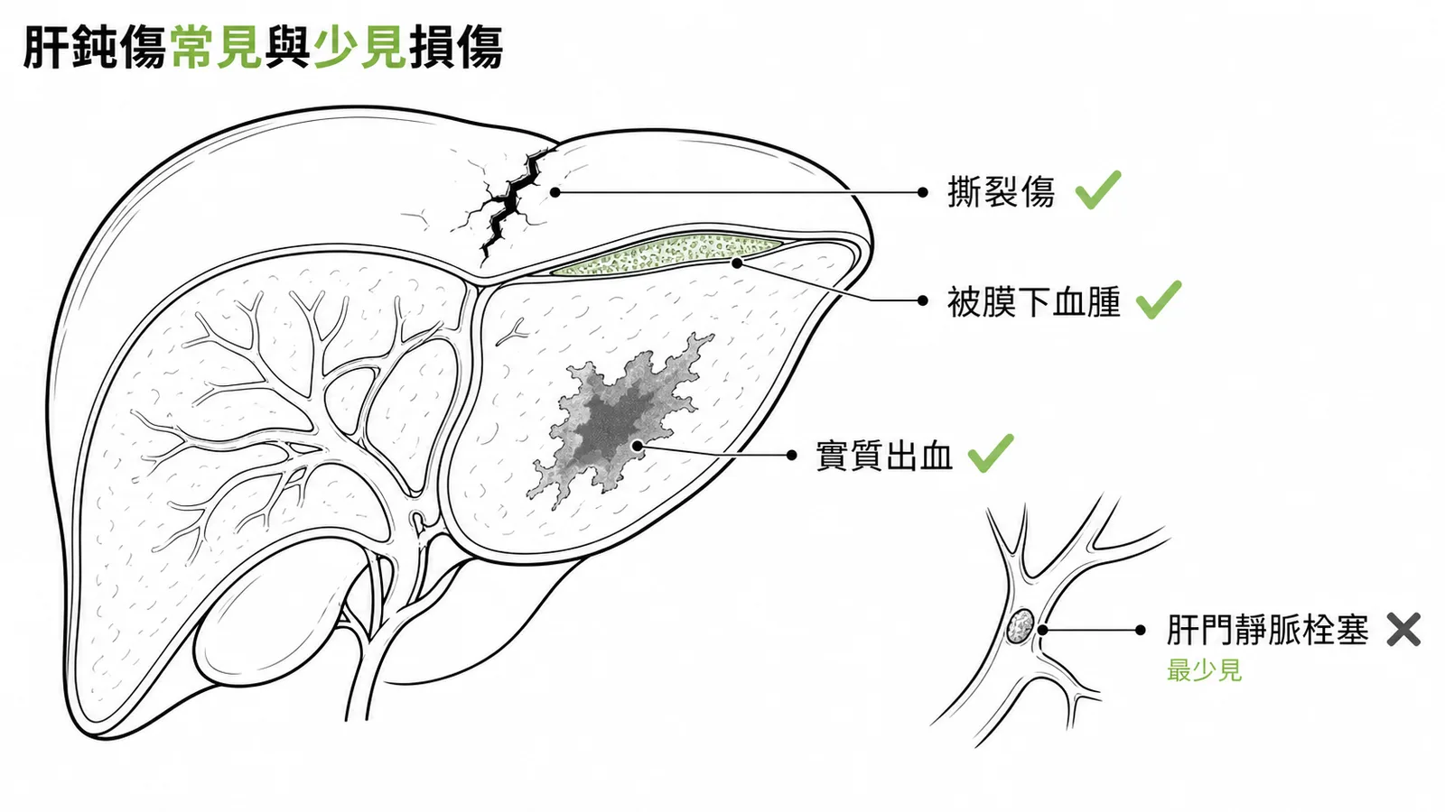 肝臟鈍傷常見損傷與少見的肝門靜脈栓塞對照