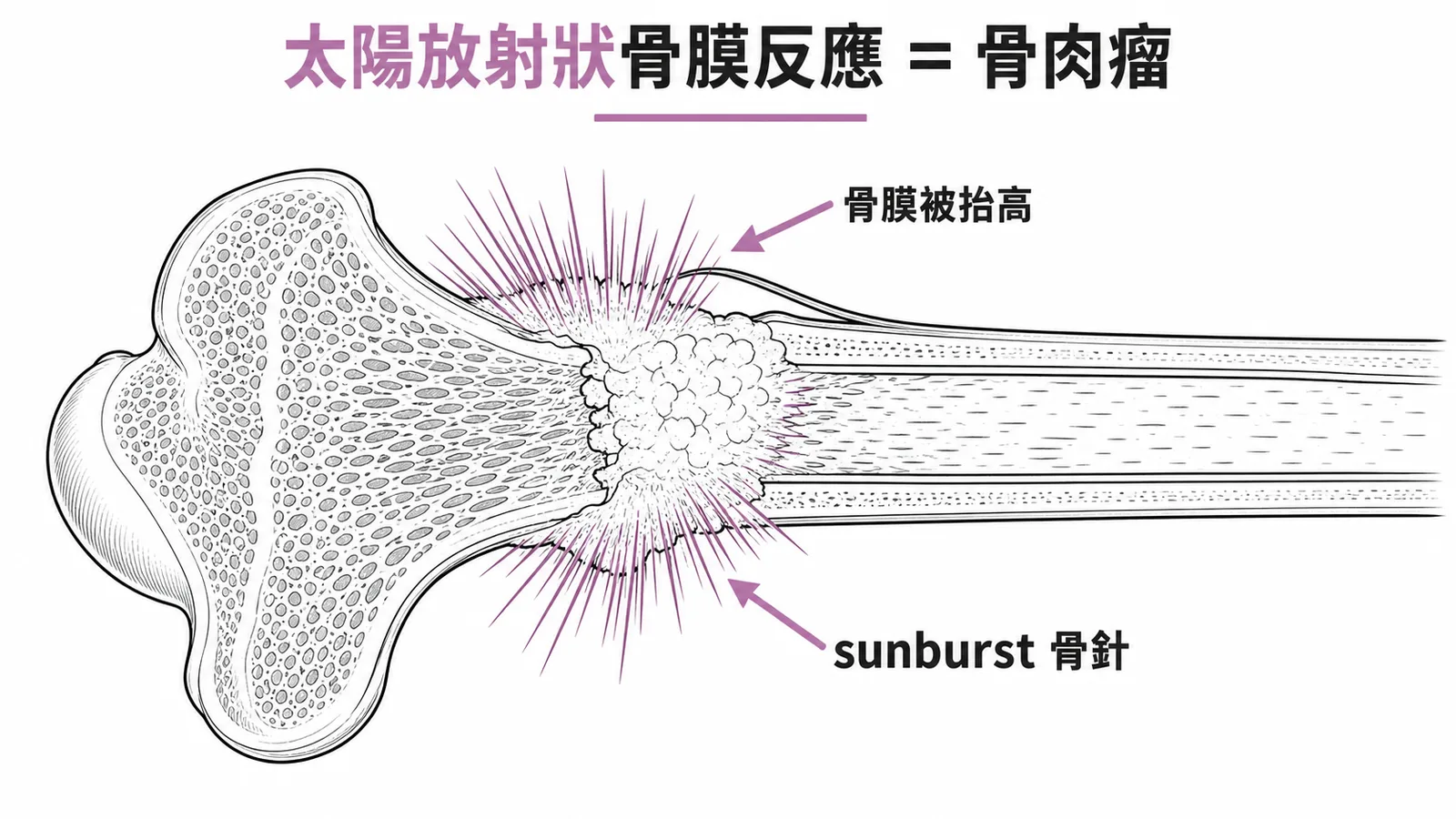 骨肉瘤太陽放射狀骨膜反應示意圖：長骨幹骺端的sunburst骨針