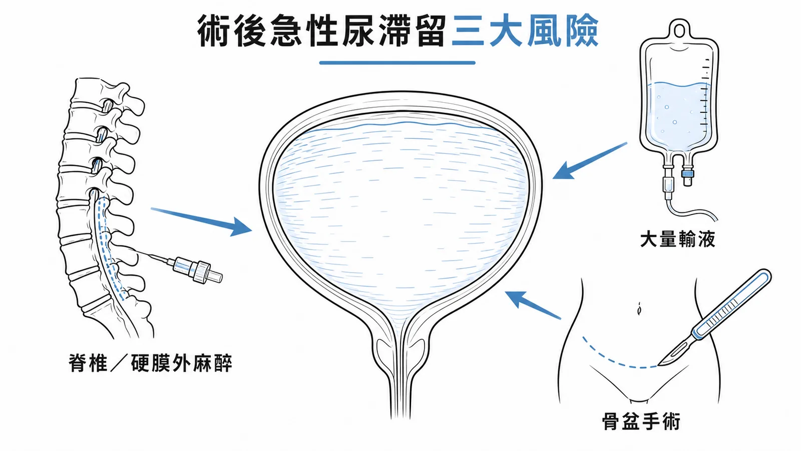 術後急性尿滯留三大風險因素示意圖