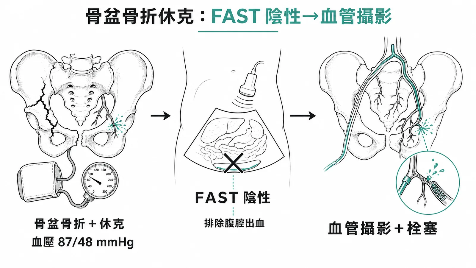 骨盆骨折休克處置流程：FAST陰性時應做血管攝影栓塞