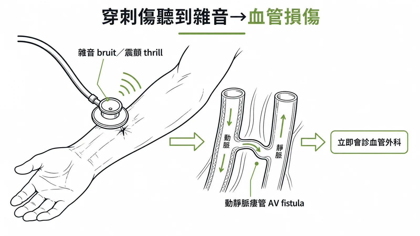 穿刺傷聽到雜音代表血管損傷：AV fistula示意圖