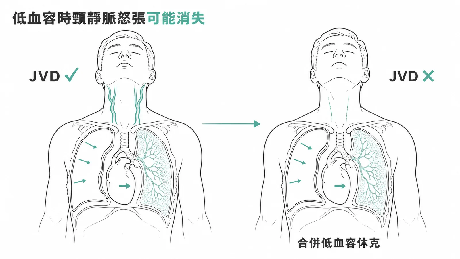 張力性氣胸合併低血容休克時頸靜脈怒張可能消失的對比示意圖