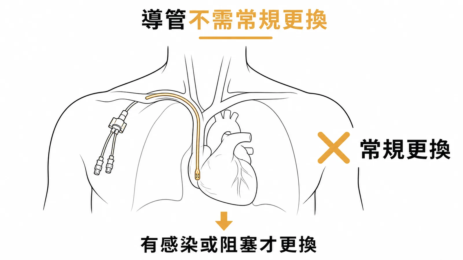 中心靜脈導管不應常規更換的示意圖