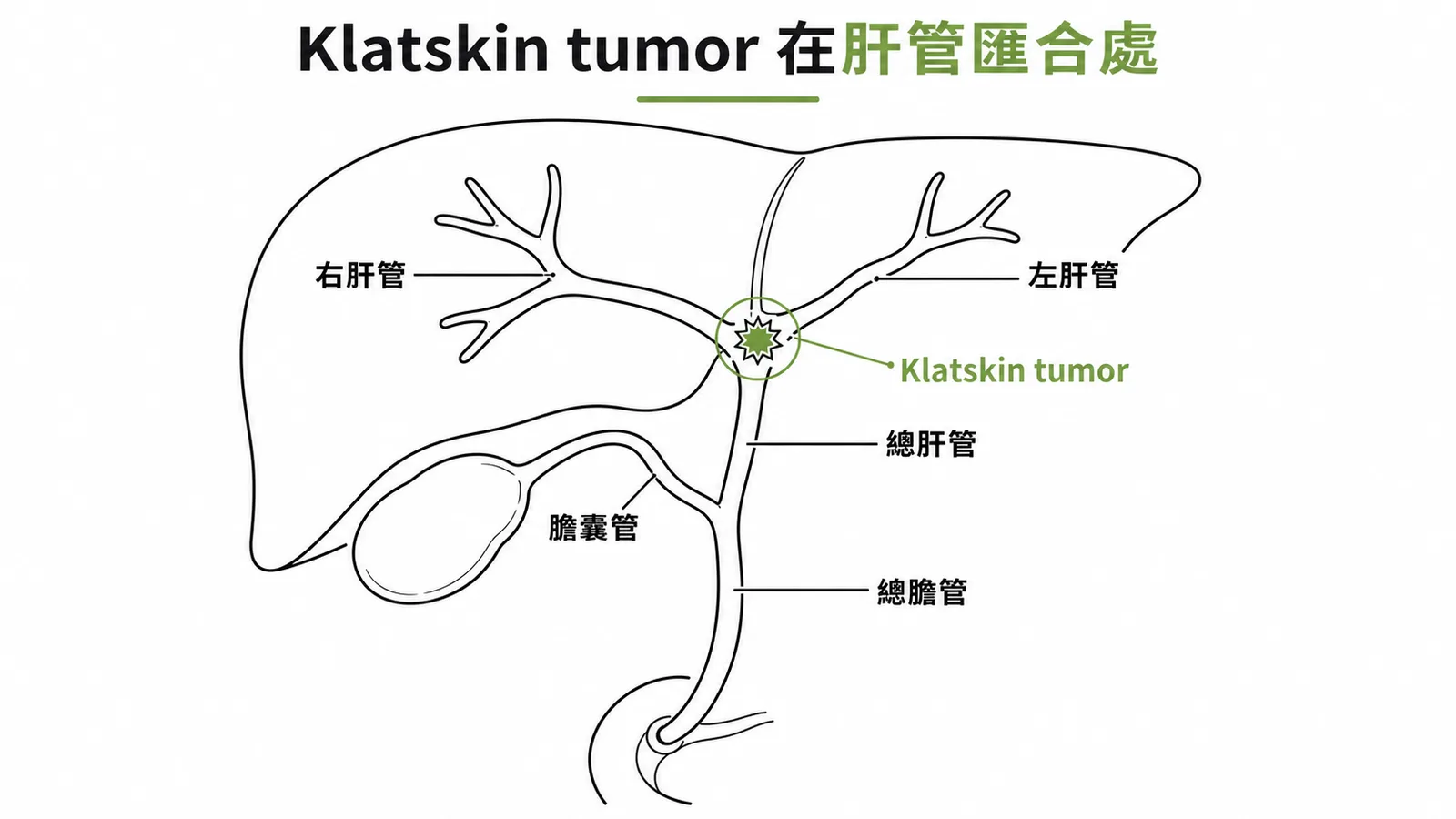 Klatskin tumor位於左右肝管匯合處的膽道解剖示意圖