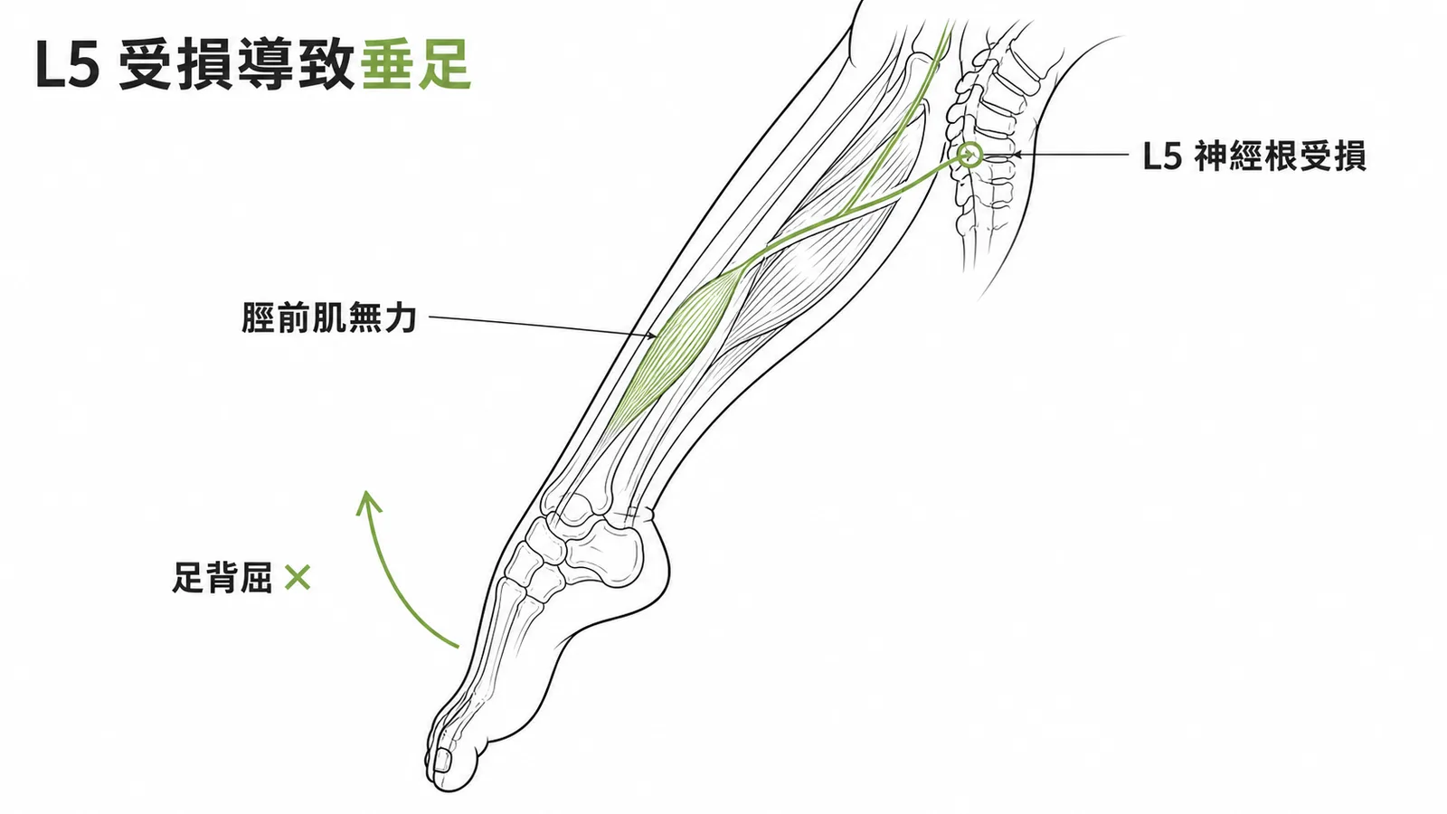 L5神經根受損導致脛前肌無力和垂足的解剖示意圖