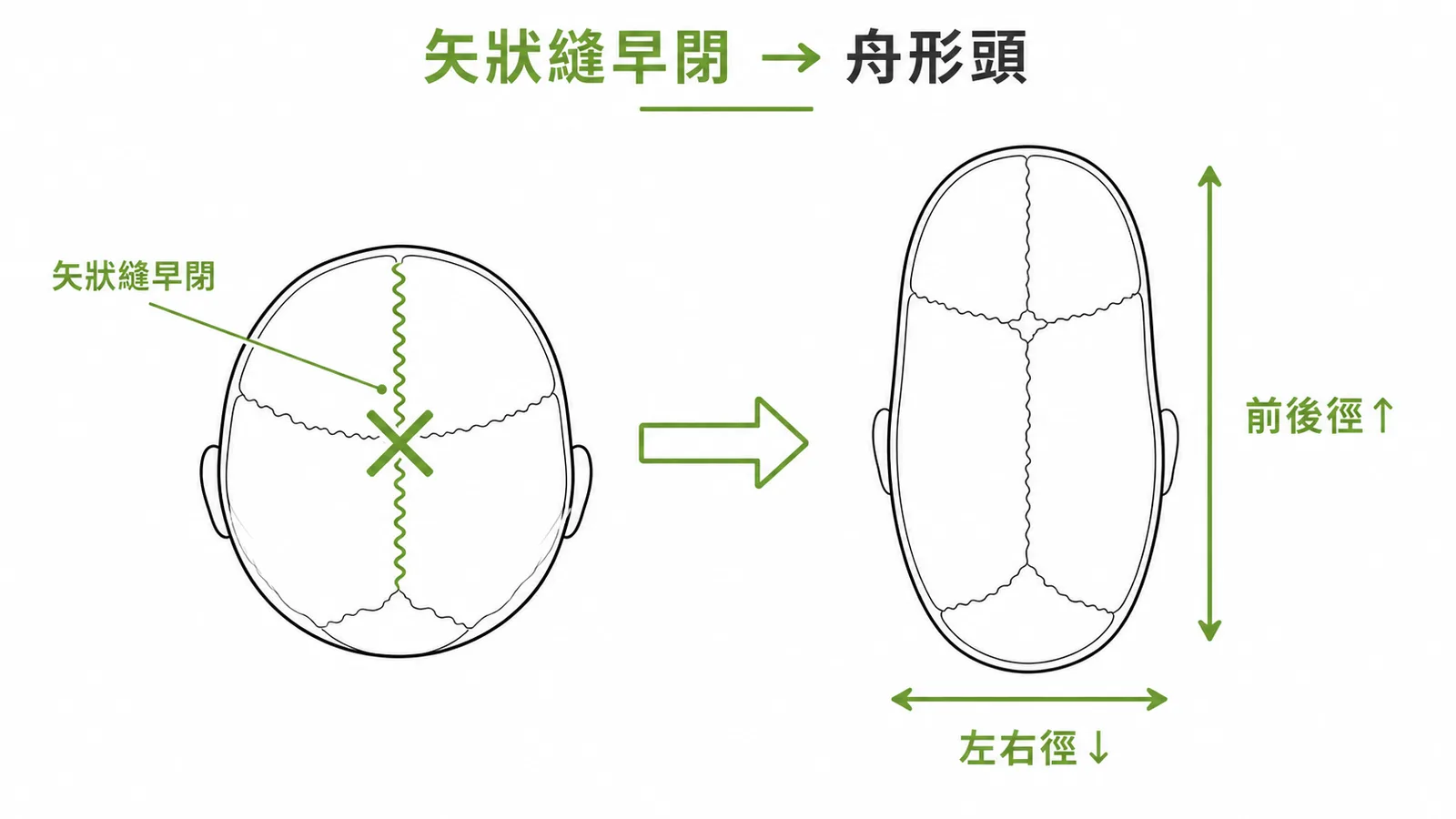 矢狀縫早閉導致舟形頭的頭型變化示意