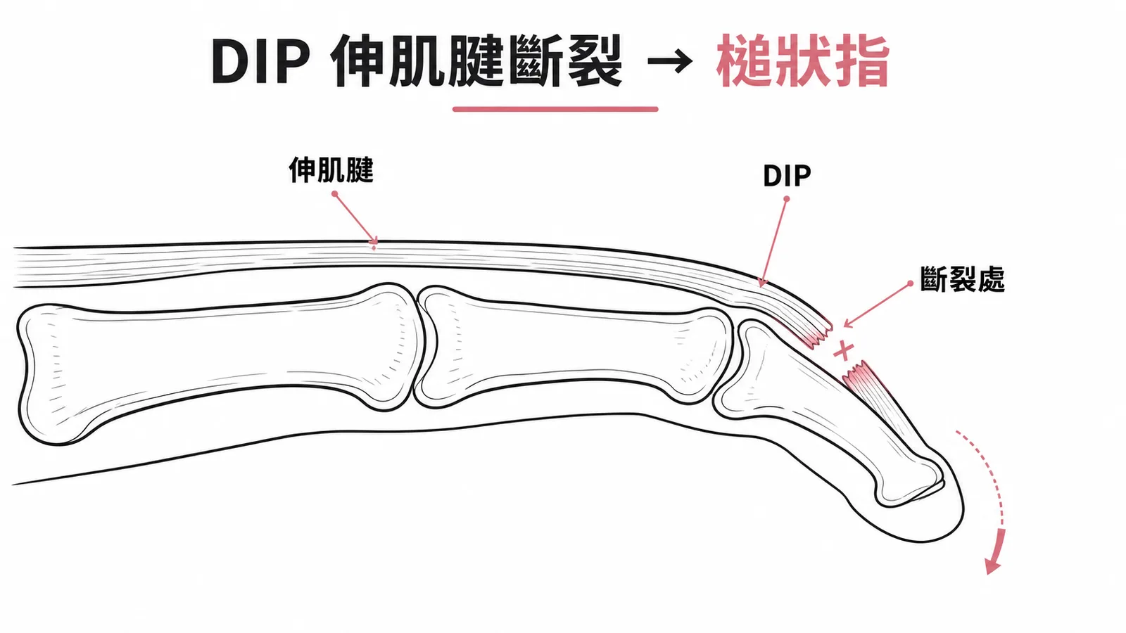 DIP伸肌腱斷裂導致槌狀指的手指解剖示意