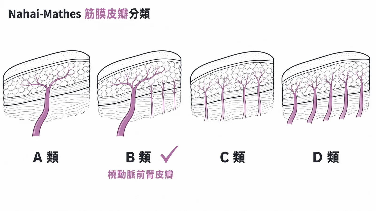 Nahai-Mathes筋膜皮瓣四類血管蒂分類示意
