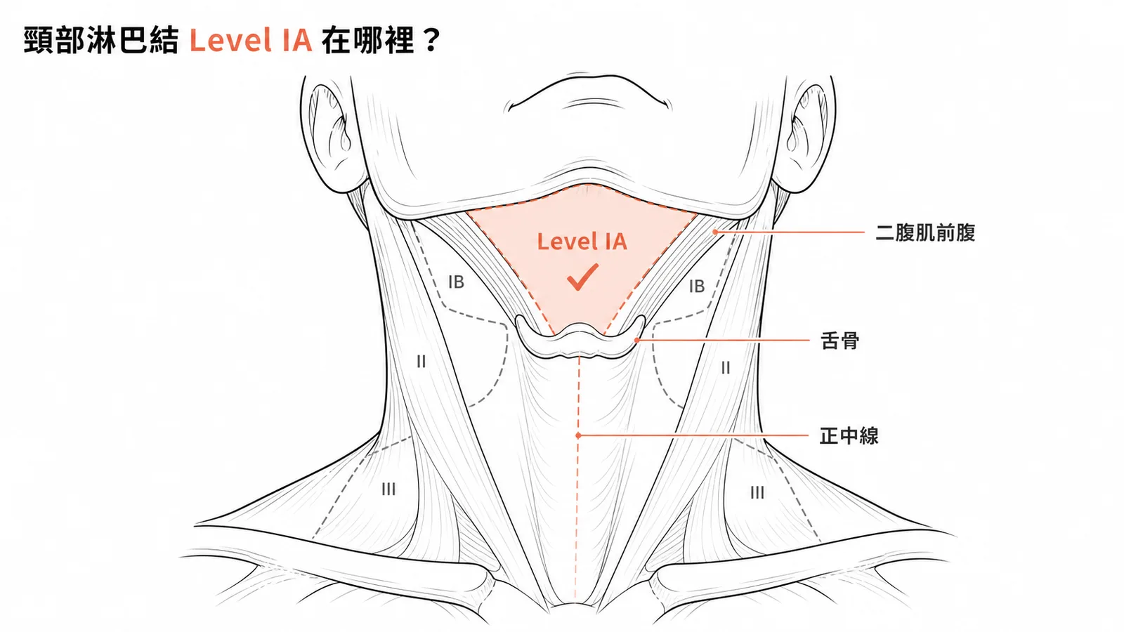 頸部淋巴結Level IA頦下三角區解剖位置