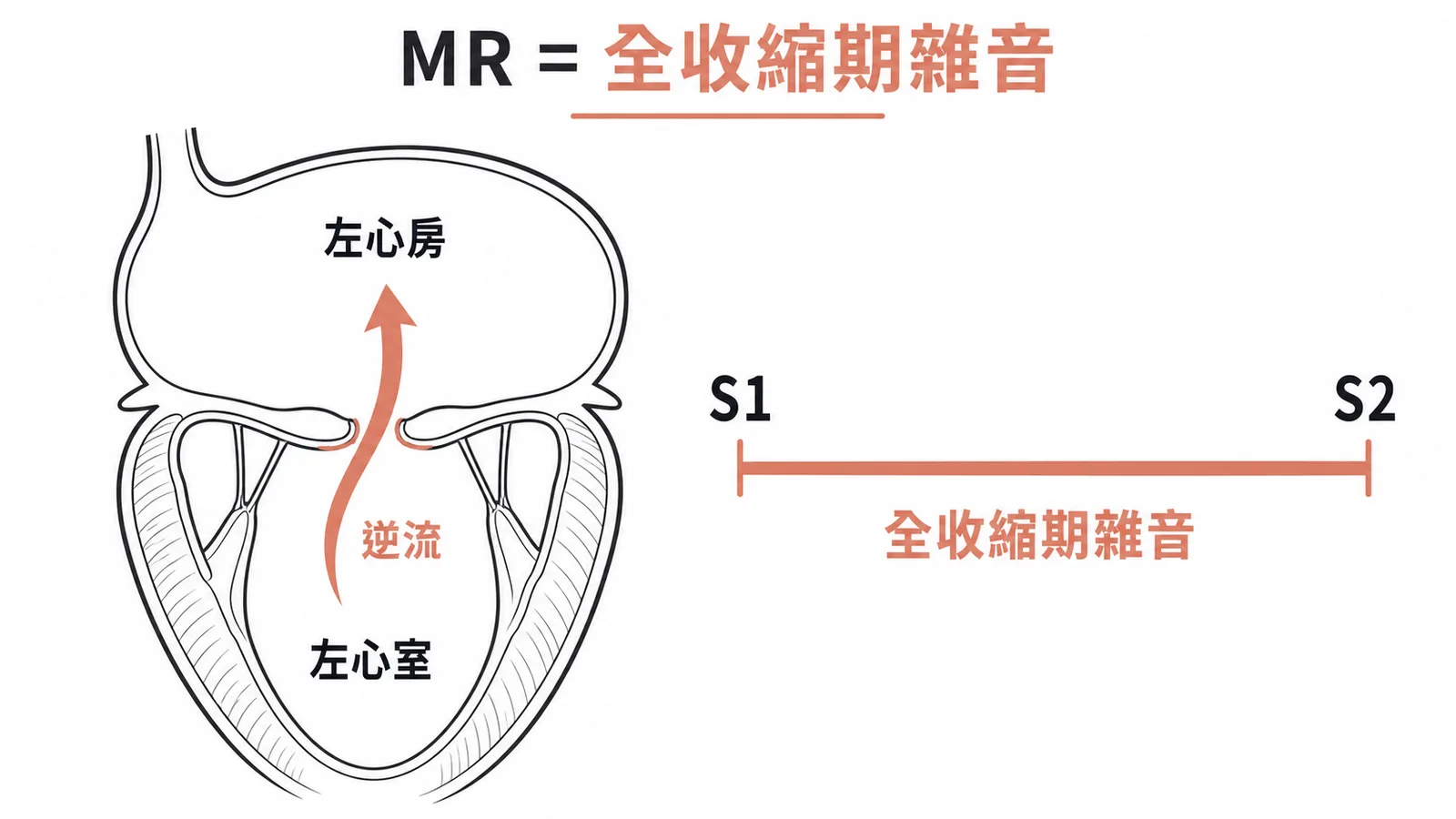 二尖瓣閉鎖不全MR全收縮期雜音與逆流方向示意
