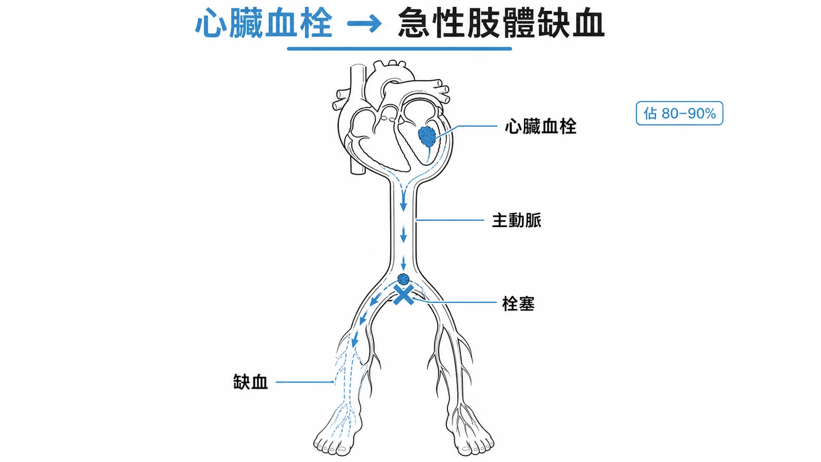 心臟血栓經主動脈栓塞至下肢造成急性肢體缺血