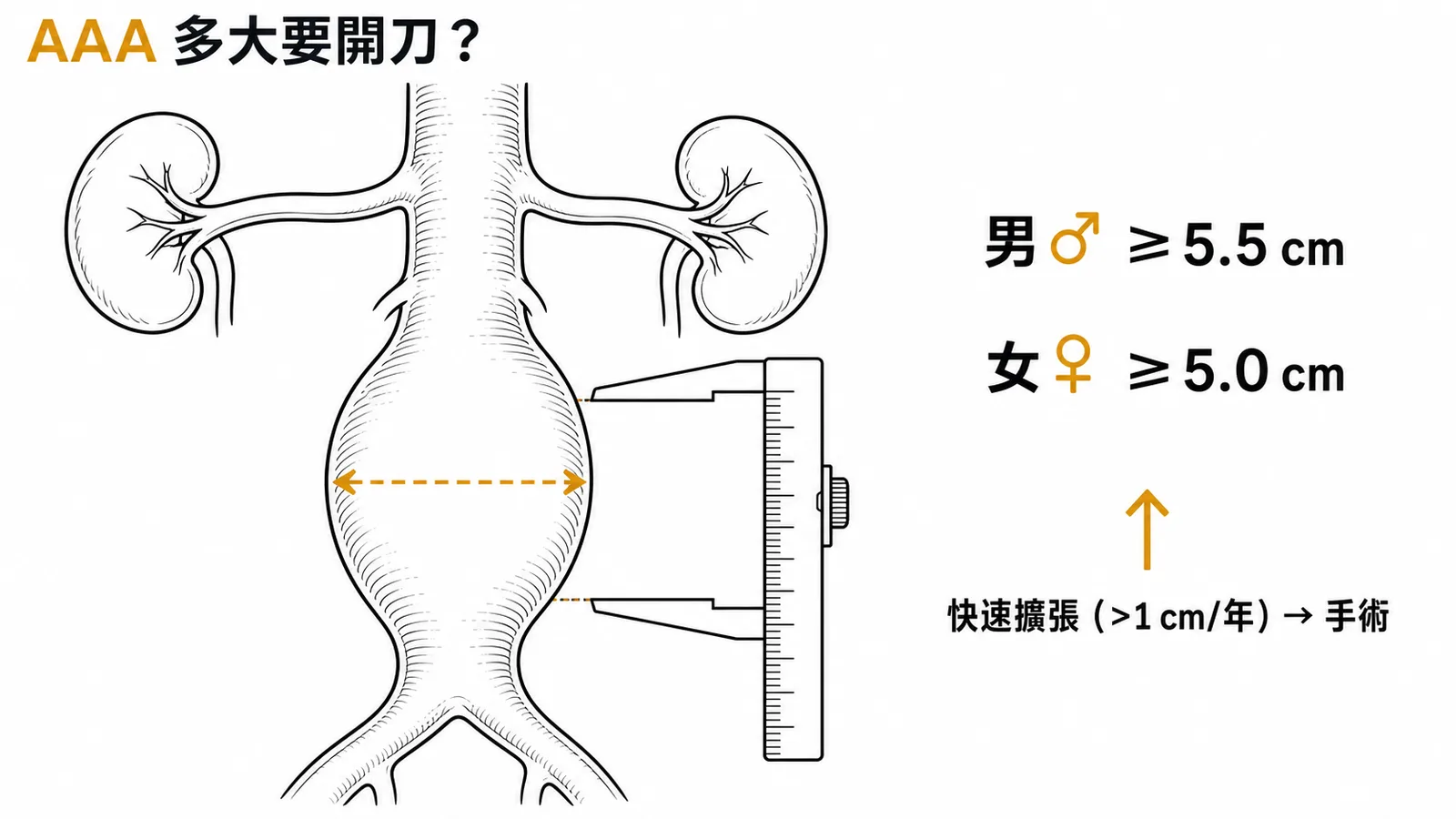 腹主動脈瘤手術門檻：男≥5.5cm、女≥5.0cm