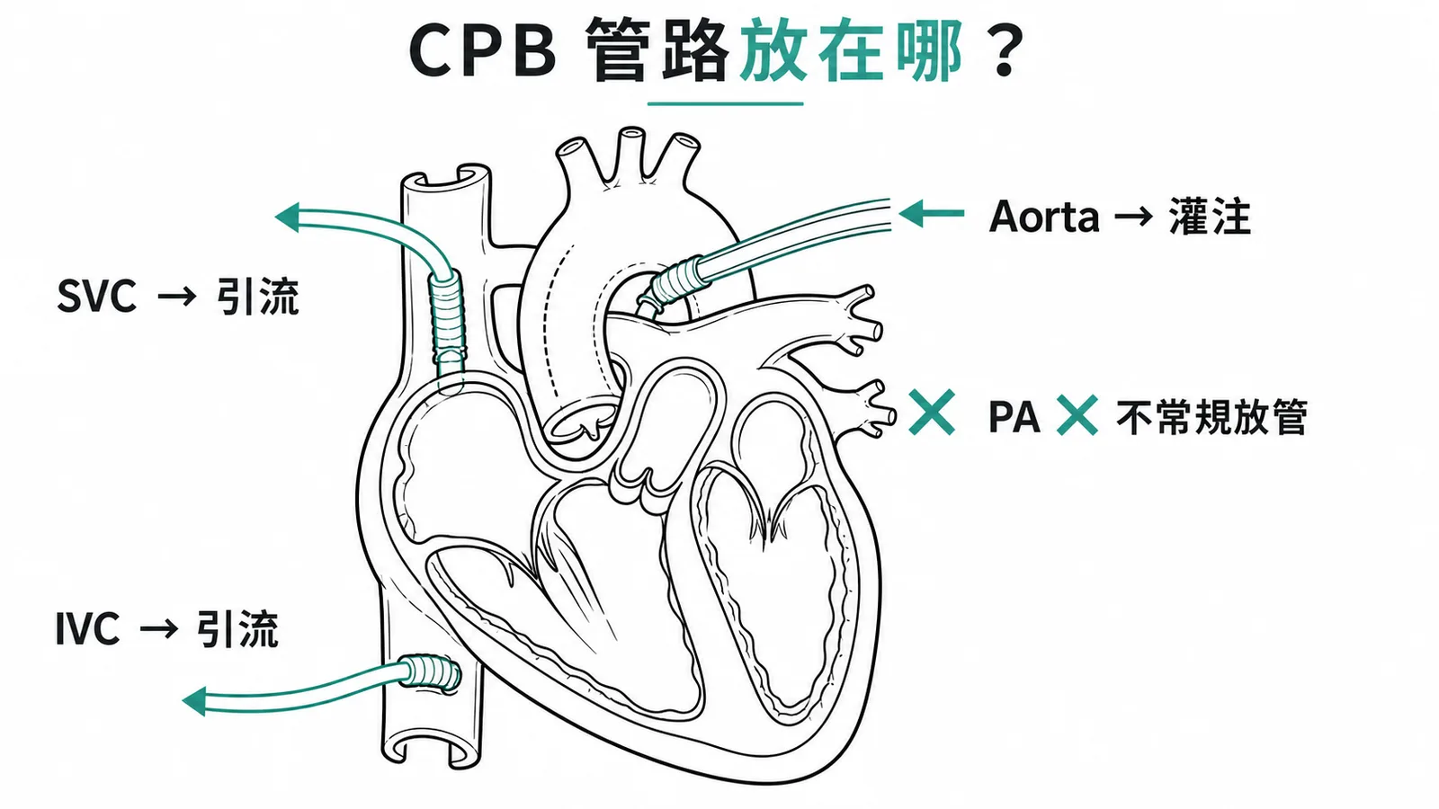 CPB管路位置：主動脈灌注、SVC/IVC引流、肺動脈不常規放管