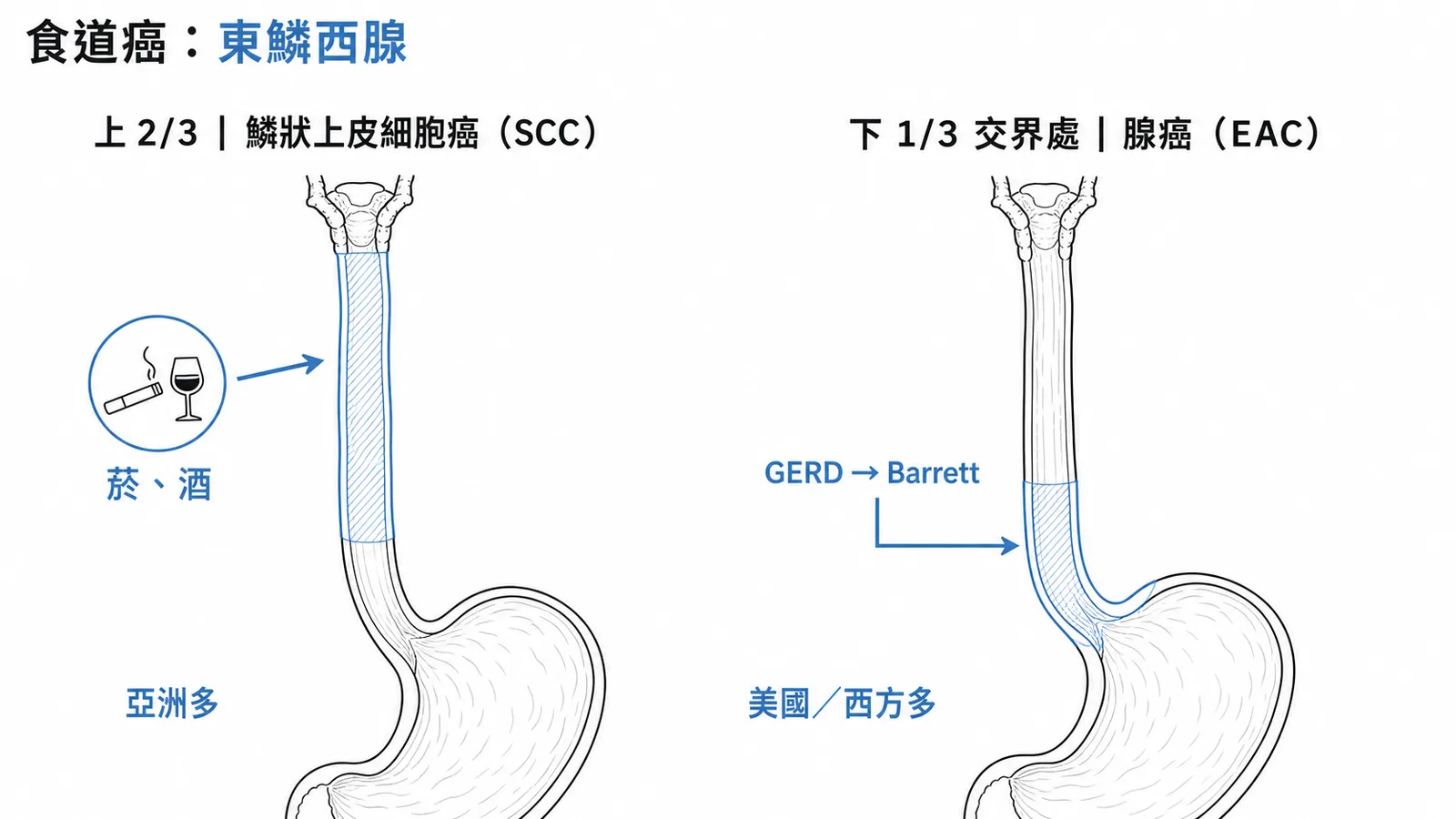 食道癌東鱗西腺：上2/3鱗癌（菸酒、亞洲）vs 下1/3腺癌（GERD→Barrett、西方）