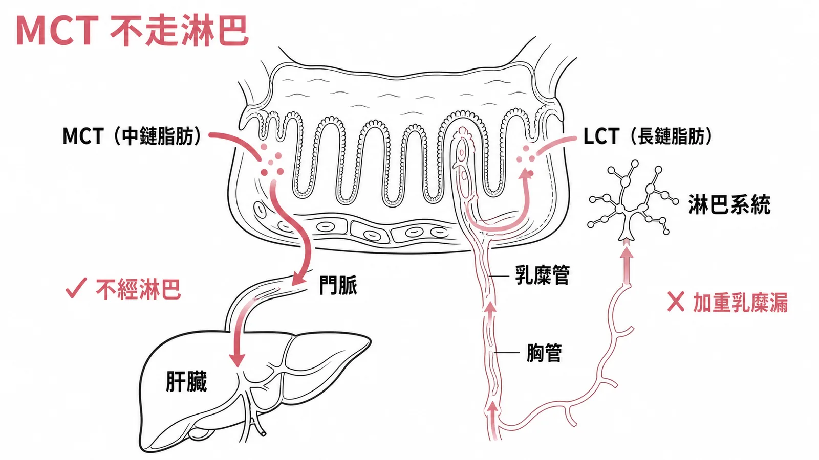 MCT不走淋巴：中鏈脂肪經門脈吸收，長鏈脂肪走淋巴加重乳糜漏