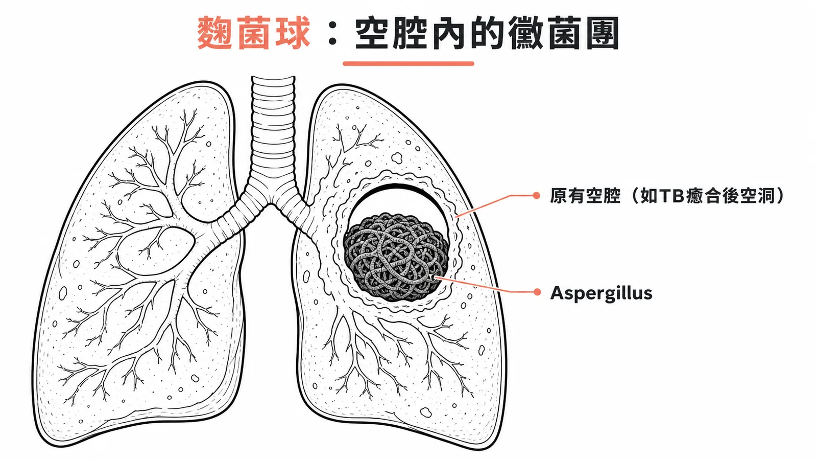 麴菌球：Aspergillus在肺部既有空腔內形成黴菌團