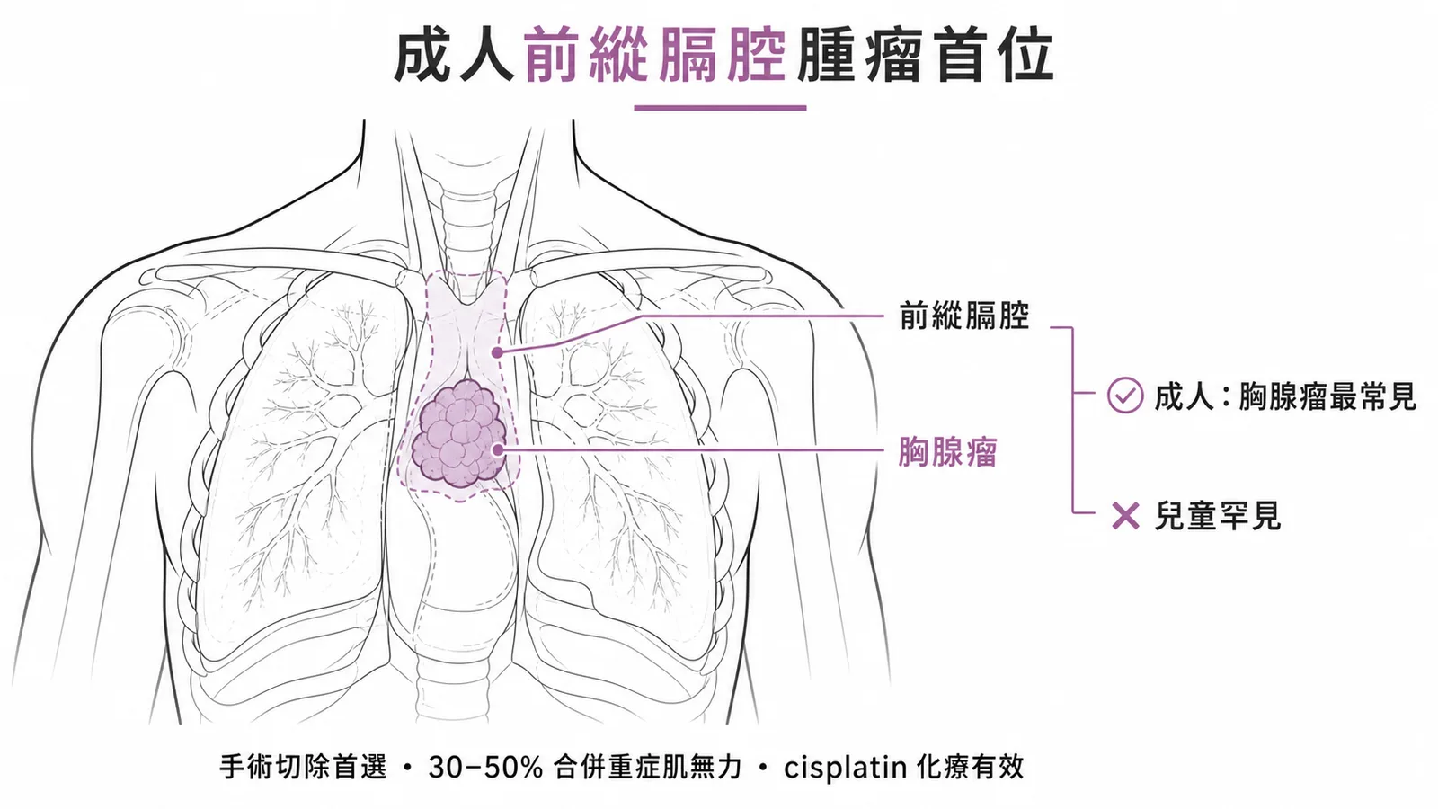 胸腺瘤：成人前縱膈腔最常見腫瘤，兒童罕見