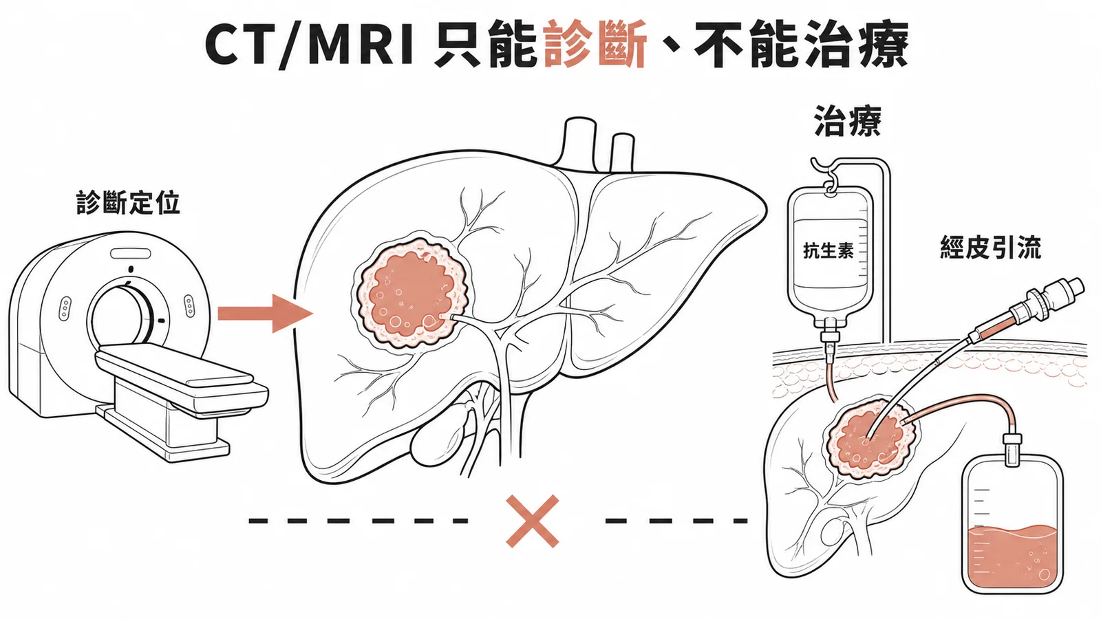 化膿性肝膿腫中CT與MRI僅用於診斷定位，治療靠抗生素加經皮引流