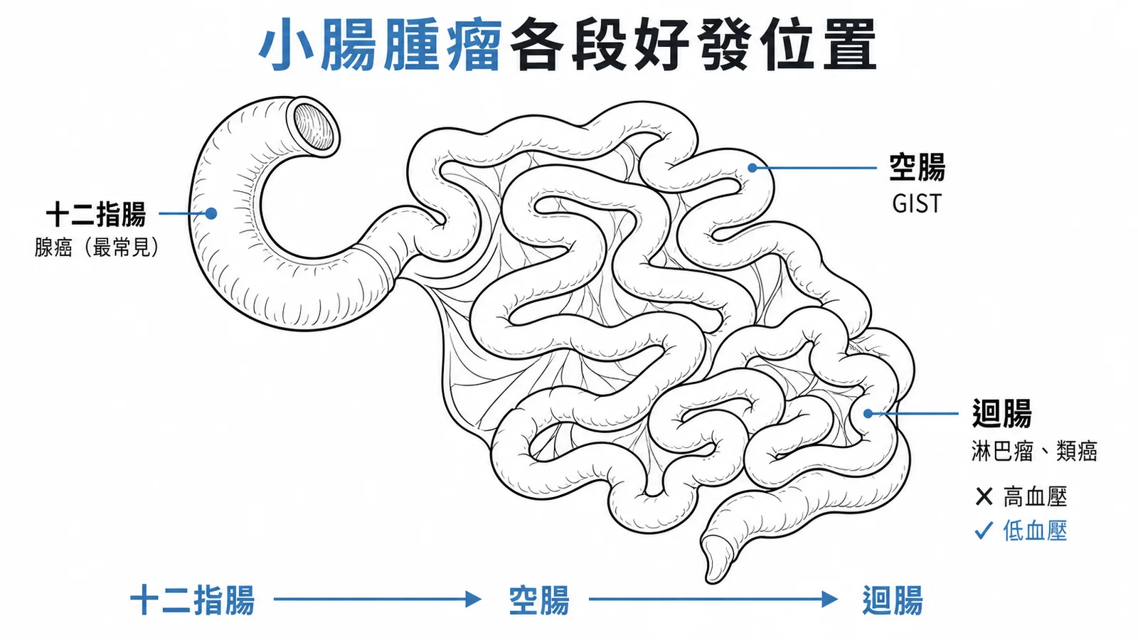 小腸各段好發腫瘤：十二指腸腺癌、空腸GIST、迴腸淋巴瘤與類癌