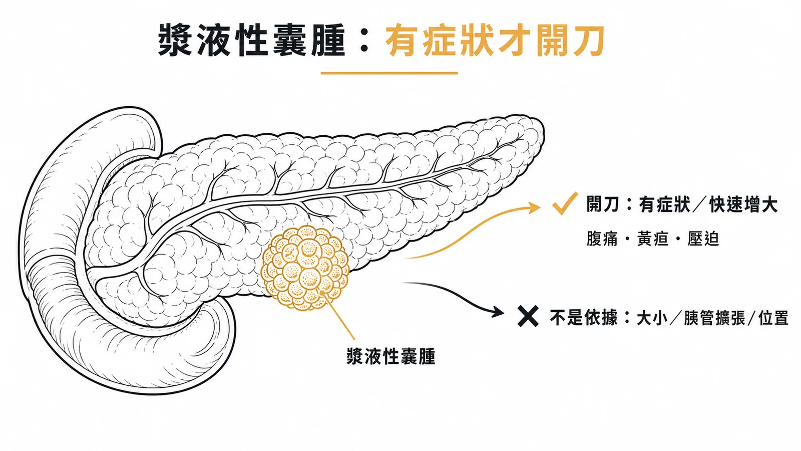 胰臟漿液性囊腫為良性，手術依據是有症狀或快速增大，而非大小、胰管擴張或位置