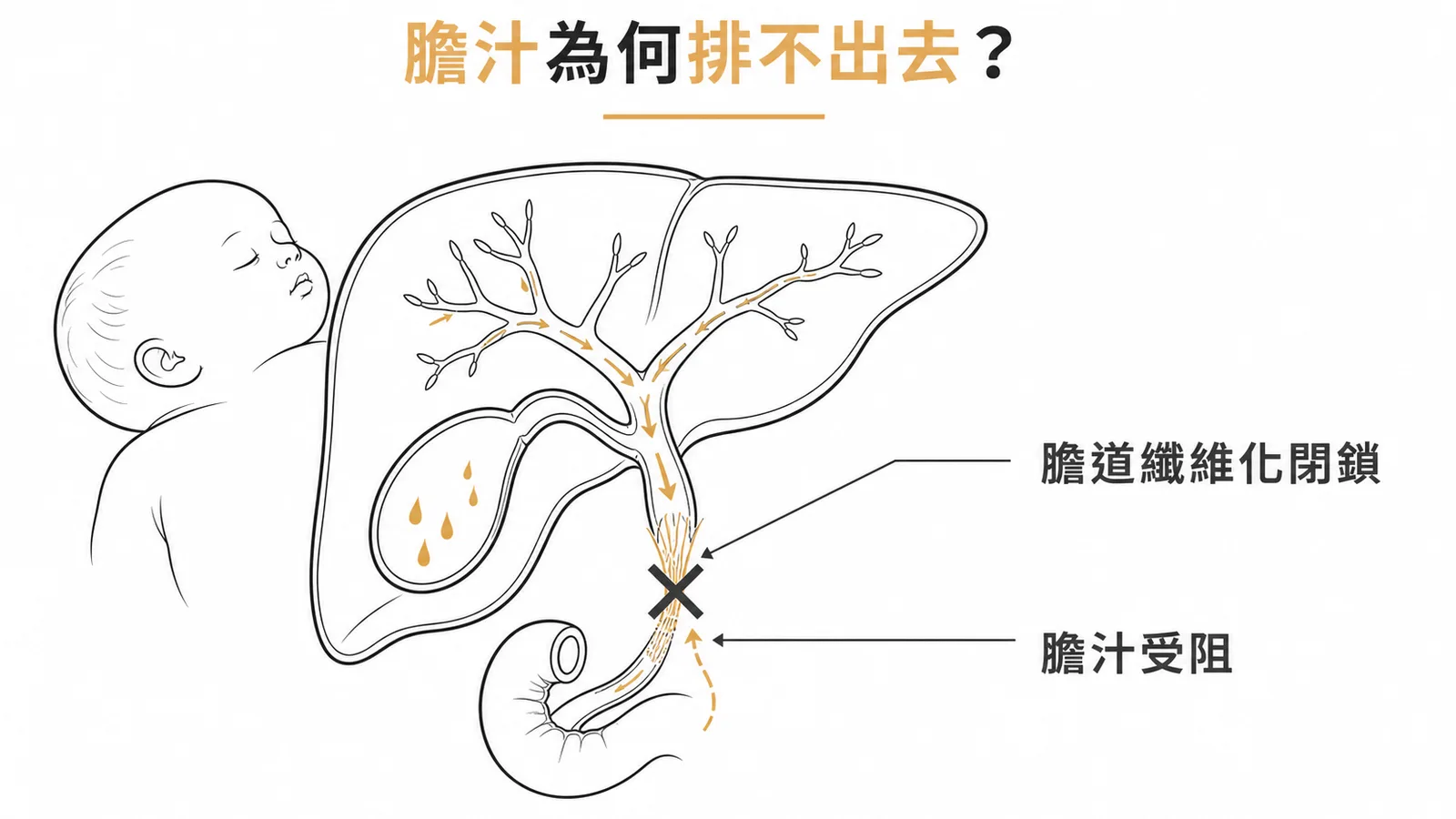 膽道閉鎖肝臟膽管纖維化閉鎖導致膽汁無法排出示意圖