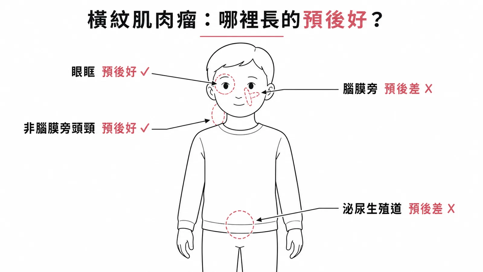橫紋肌肉瘤不同原發部位預後好壞對照圖