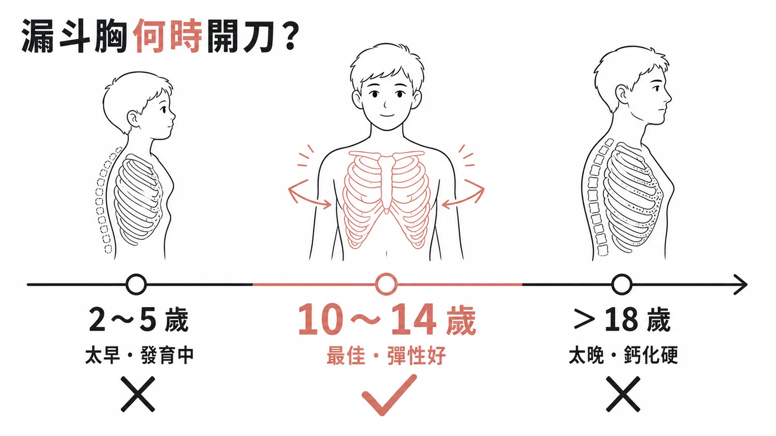 漏斗胸手術最佳時機10至14歲時間軸對照圖