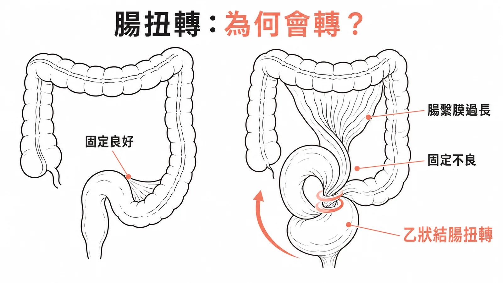 乙狀結腸扭轉原因為腸繫膜過長與固定不良示意圖