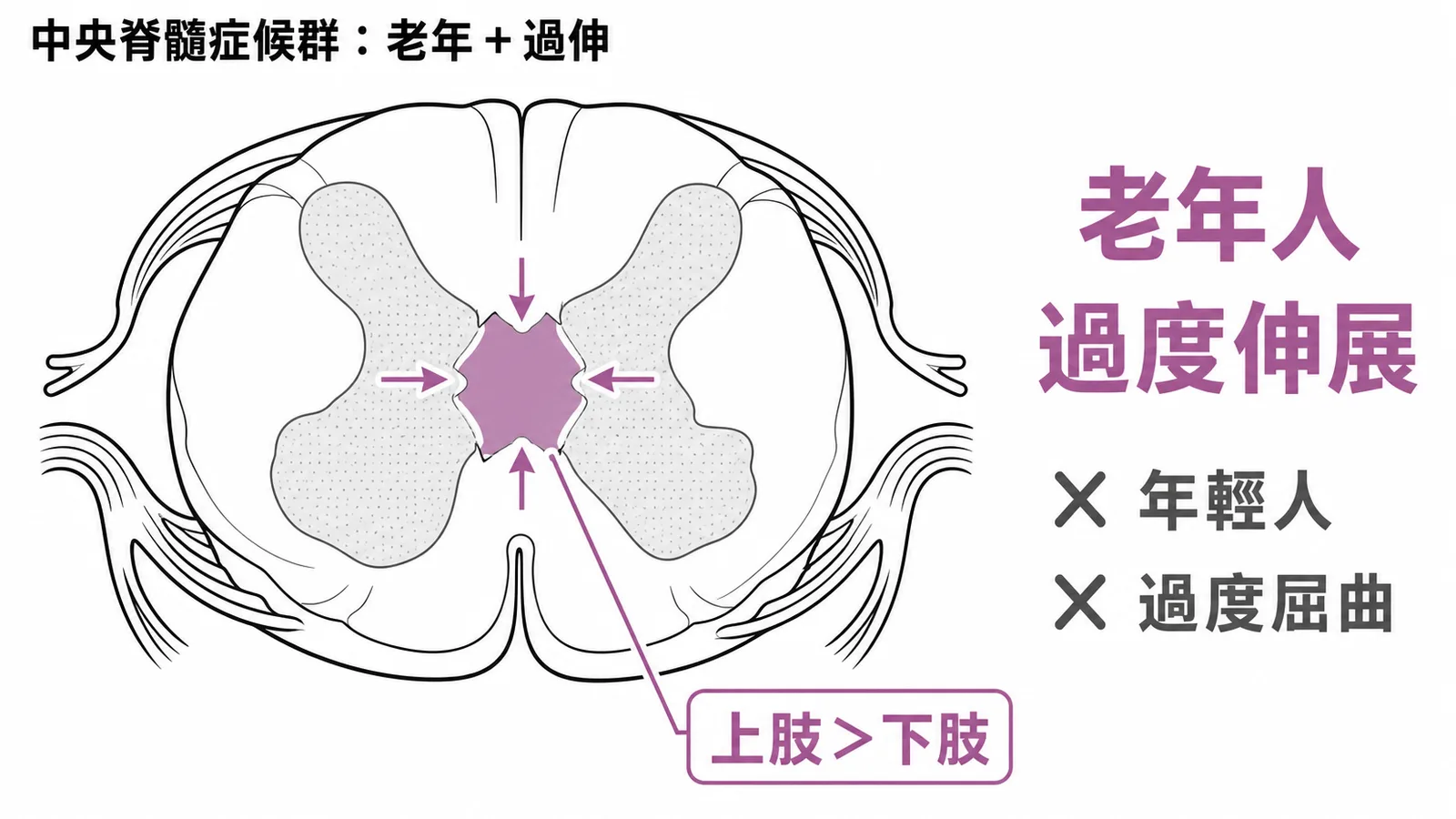 中央脊髓症候群示意圖:好發老年人過度伸展、上肢無力大於下肢