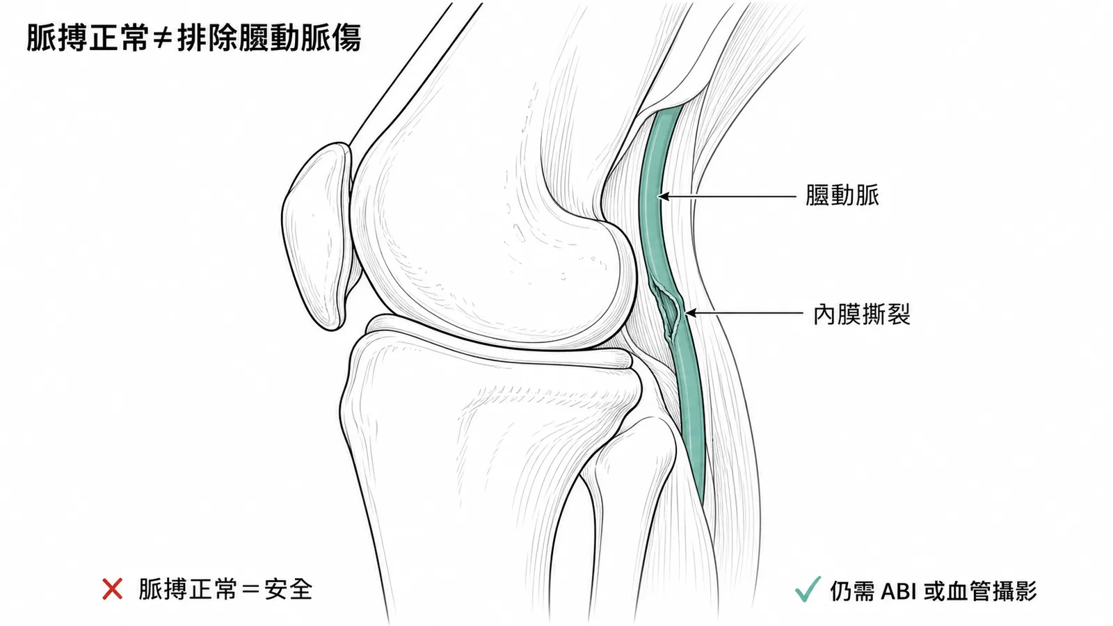 膝關節脫臼膕動脈損傷示意圖:脈搏正常不能排除血管傷