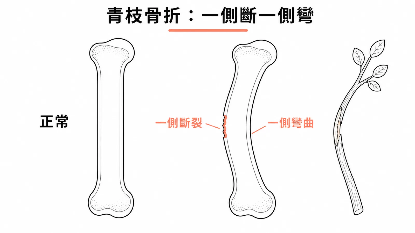 青枝骨折示意圖:一側皮質斷裂另一側彎曲如折嫩枝
