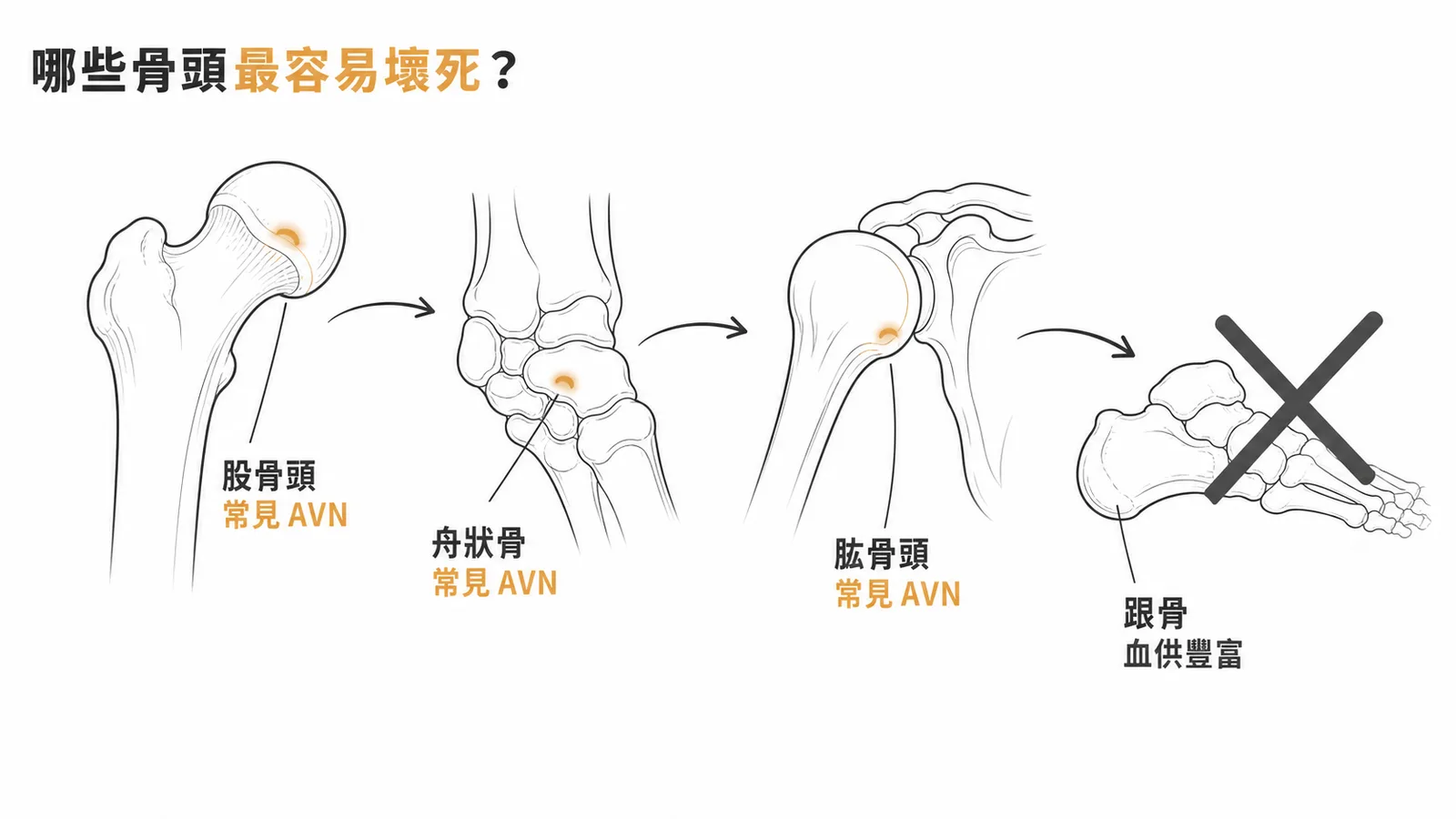 骨壞死常見部位為股骨頭、舟狀骨、肱骨頭,跟骨因血供豐富最不常見