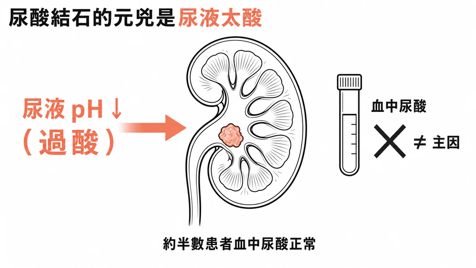 尿酸結石的主因是尿液過酸而非血中尿酸高，約半數患者血中尿酸正常